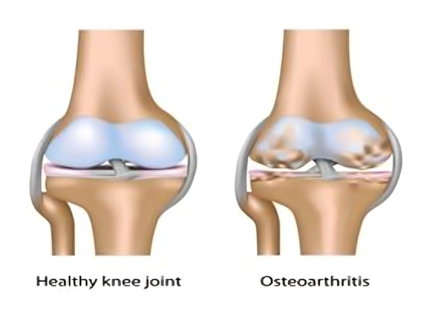 Joint and Bone Care